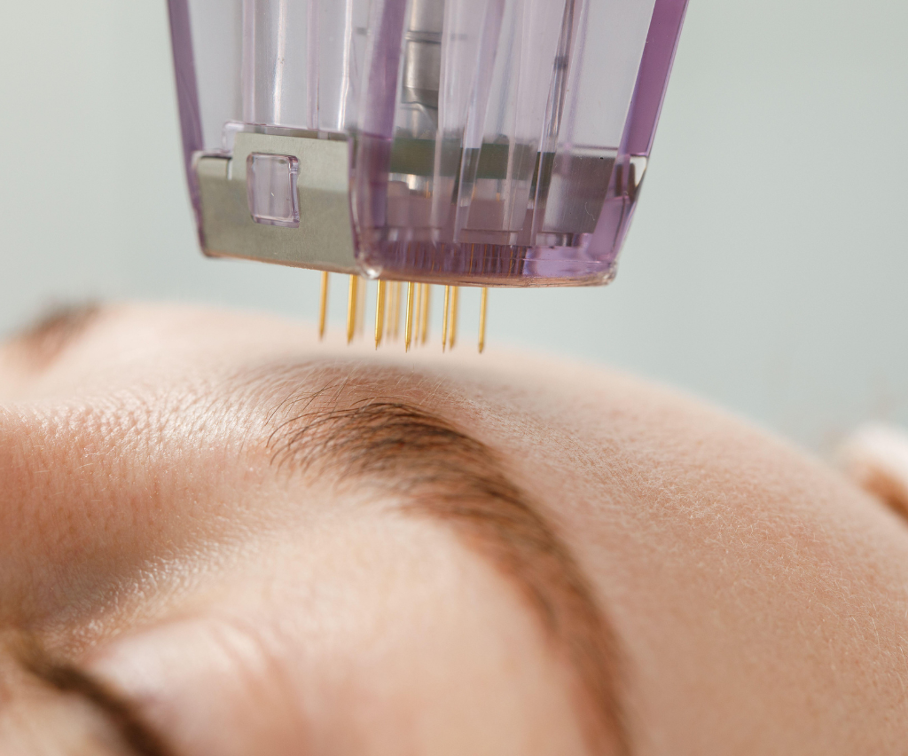 Micro Needling