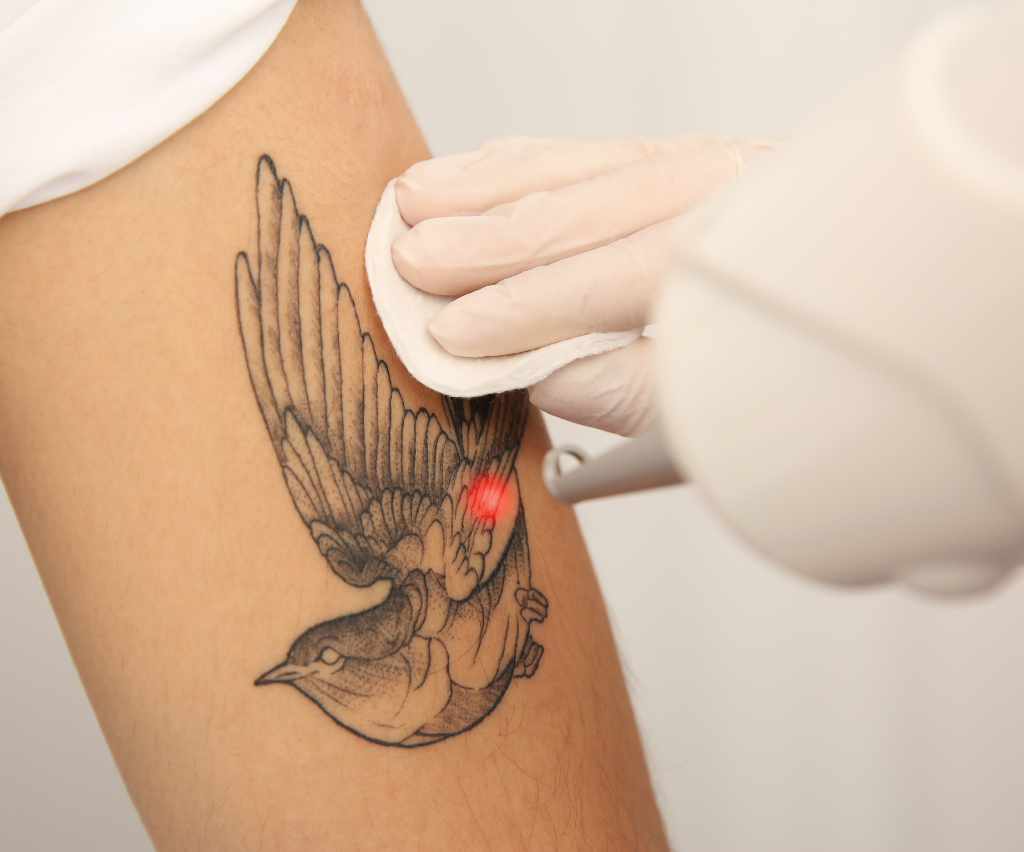 Tattoo Removal